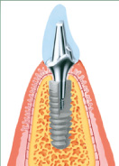 implants dental implants upton