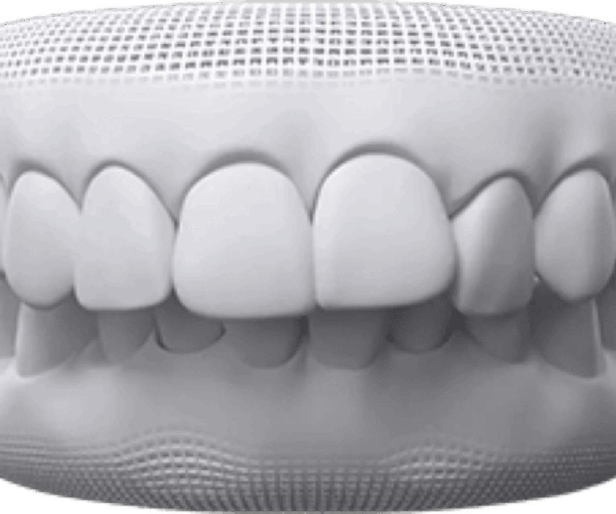 Overbite
